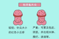 严重的龟头炎能治好吗？